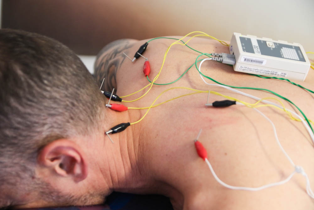 Electroacupuntura en fisioterapia en Atfisio