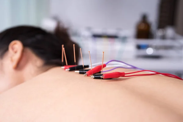 Electroneuroacupuncture treatment in clinic